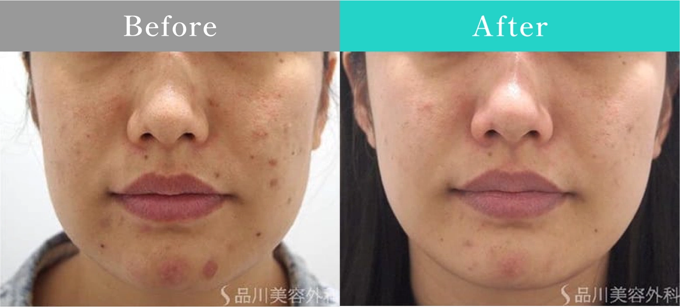 症例写真 Before After 02
