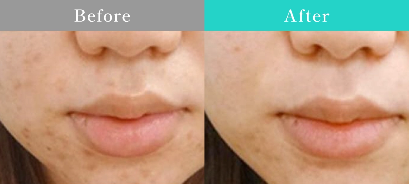 症例写真 Before After 01