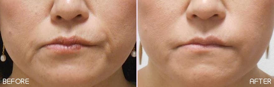 美肌注射の症例写真