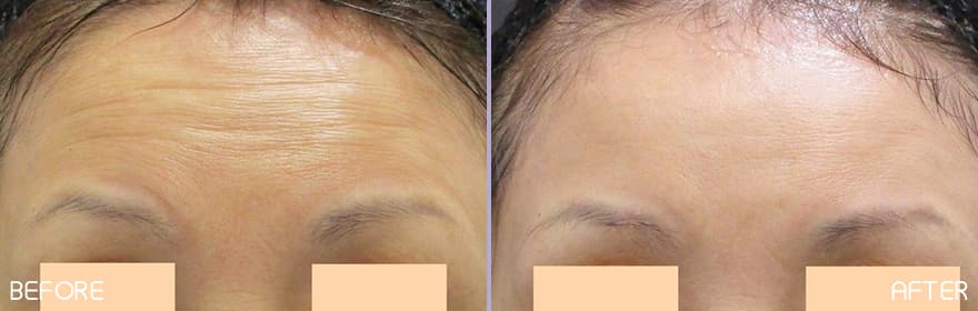 美肌注射×アラガン社ボツリヌス注射 症例写真