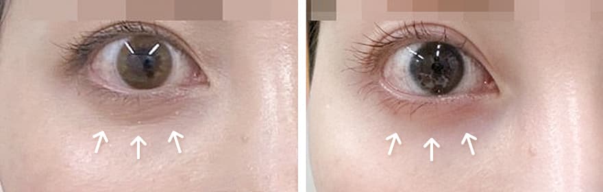 美肌注射 目の下（片目1ccずつ）5回目の症例写真