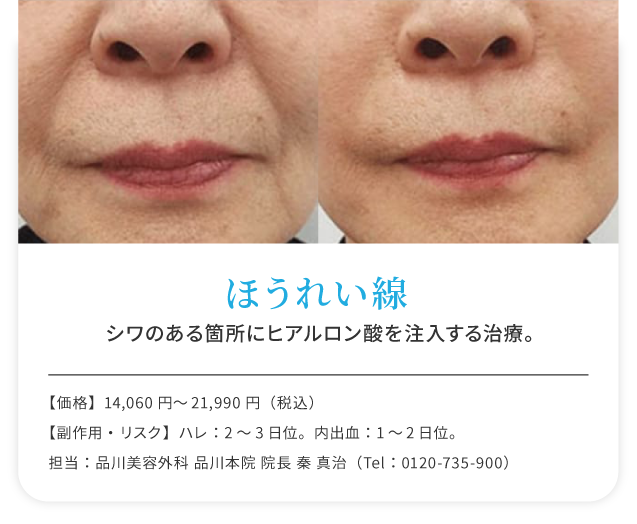 ほうれい線