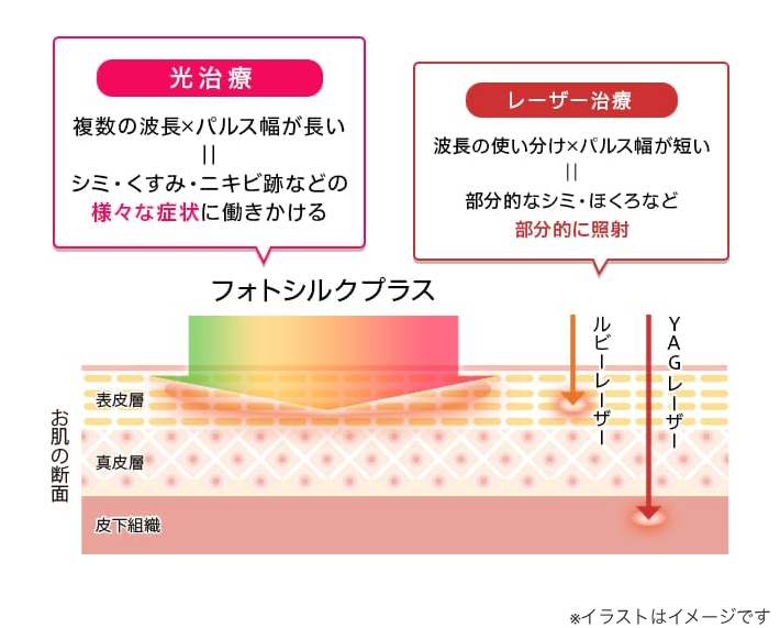 光治療とレーザー治療違いのイメージ
