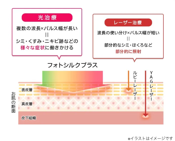 光治療とレーザー治療違いのイメージ