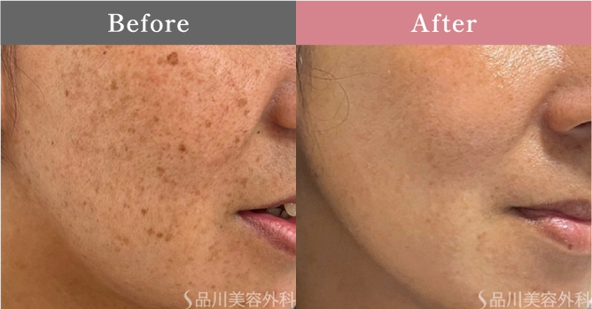 症例写真 Before After 01