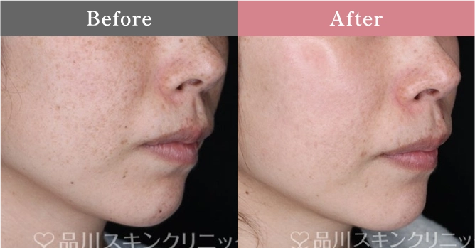 症例写真 Before After 02