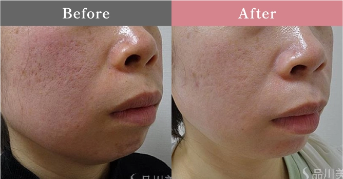 症例写真 Before After 03