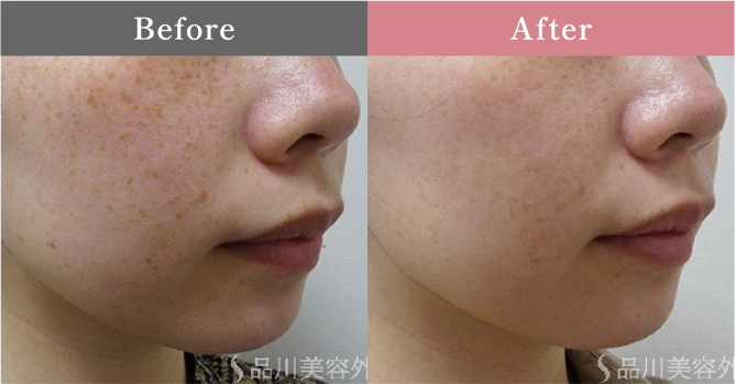 症例写真 Before After 04