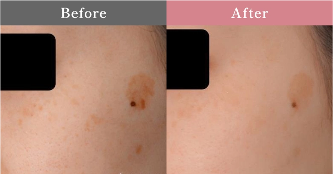 症例写真 Before After 05