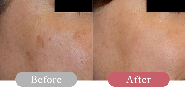 症例写真 Before After 01