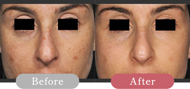 症例写真 Before After 02