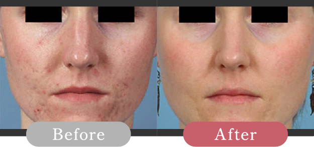 症例写真 Before After 03