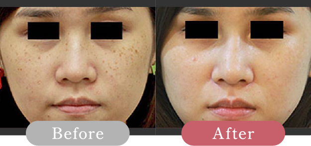 症例写真 Before After 01