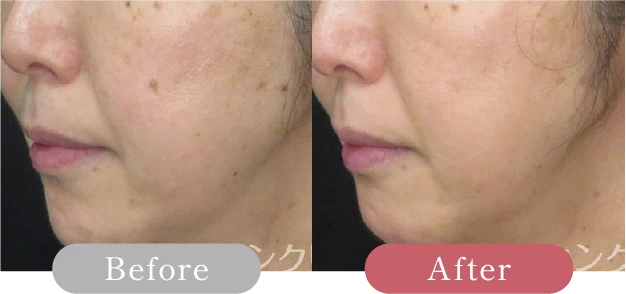 症例写真 Before After 03