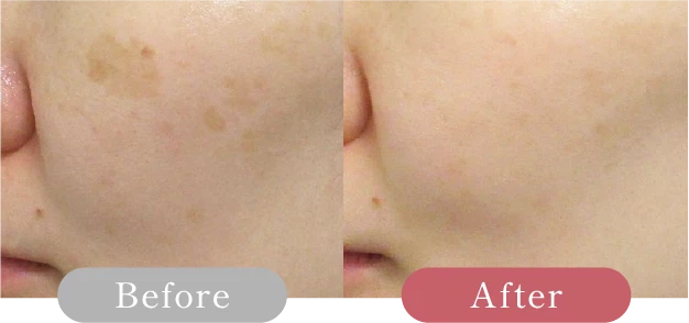 症例写真 Before After 04