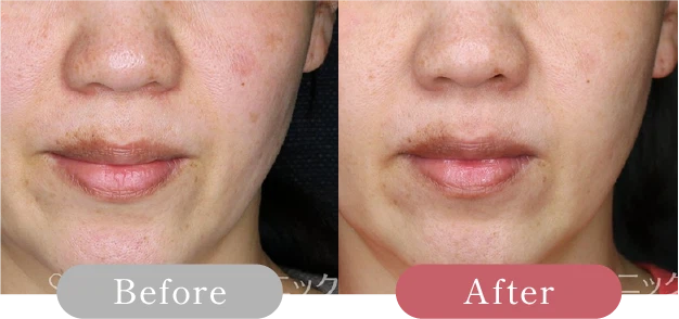 症例写真 Before After 05