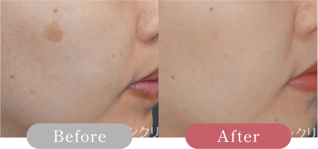 症例写真 Before After 05