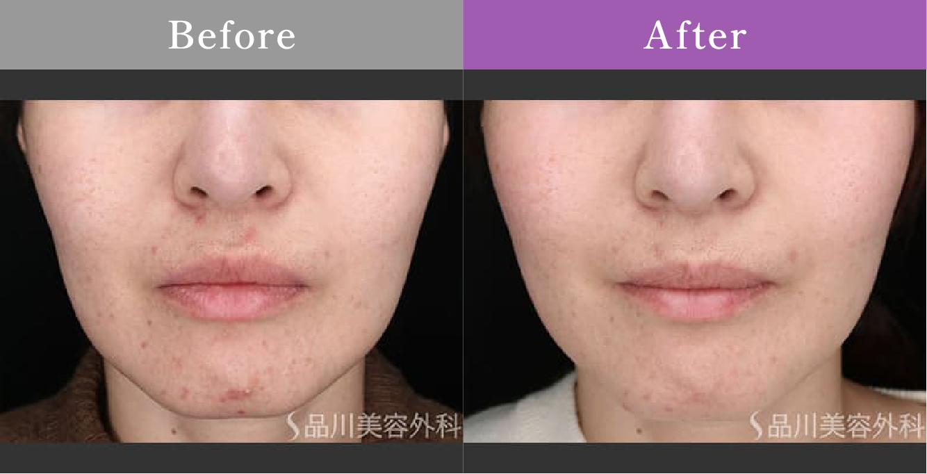 症例写真 Before After 01
