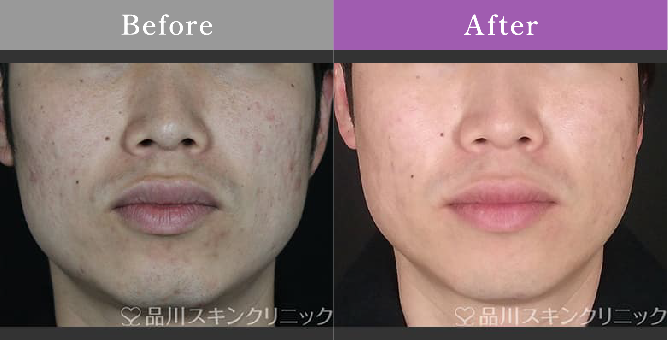 症例写真 Before After 02