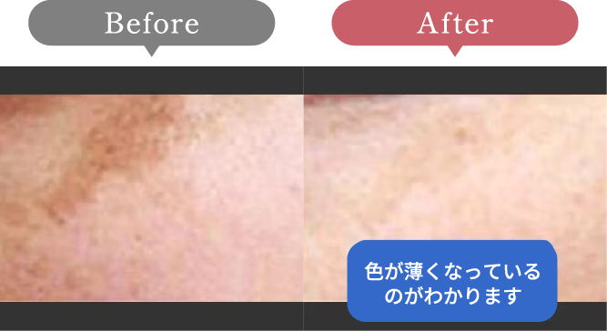 症例写真 Before After 01