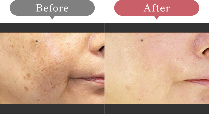 症例写真 Before After 02