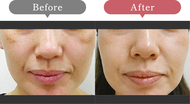 症例写真 Before After 03