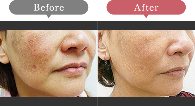 症例写真 Before After 04