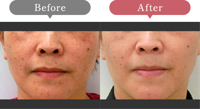 症例写真 Before After 05