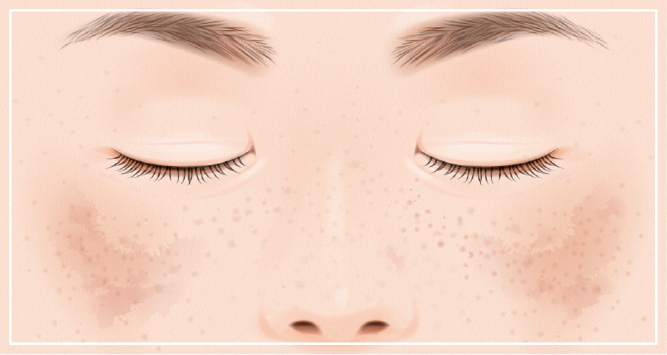 レーザートーニングとは