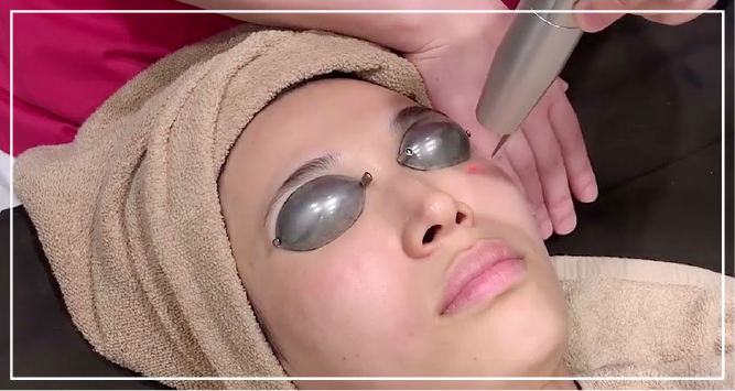 レーザートーニングとは