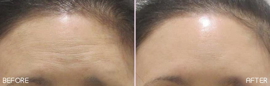 美肌注射の症例写真