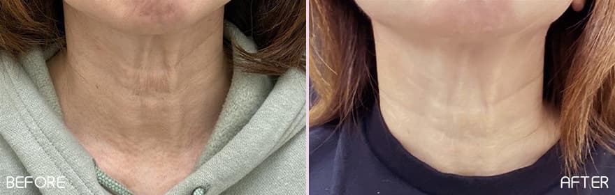 美肌注射の症例写真