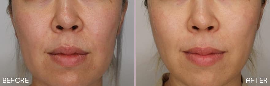 美肌注射×美肌リフト 症例写真
