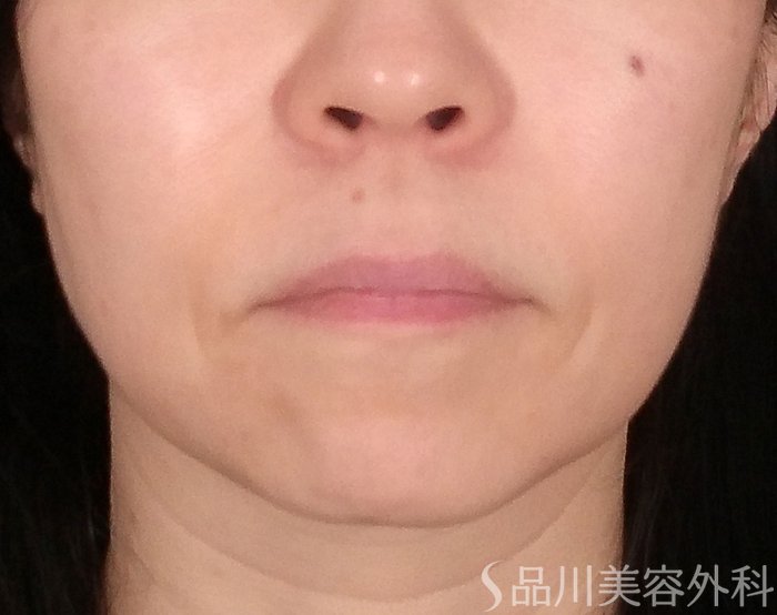 「美肌糸リフト」症例写真 Before
