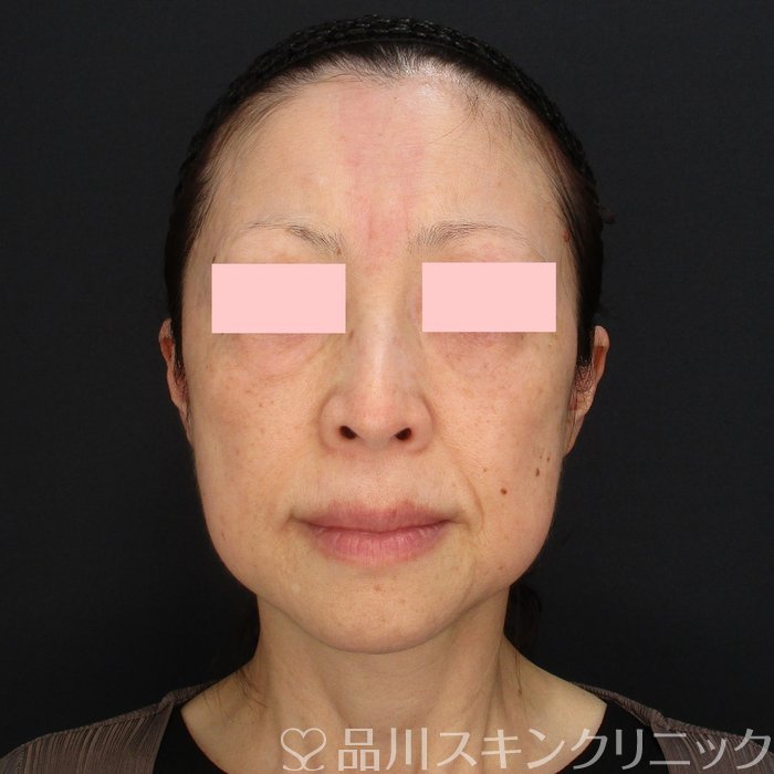 「美肌糸リフト」症例写真 Before