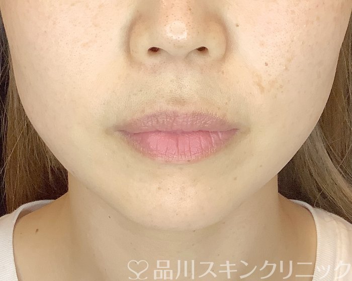 「美肌糸リフト」症例写真 After