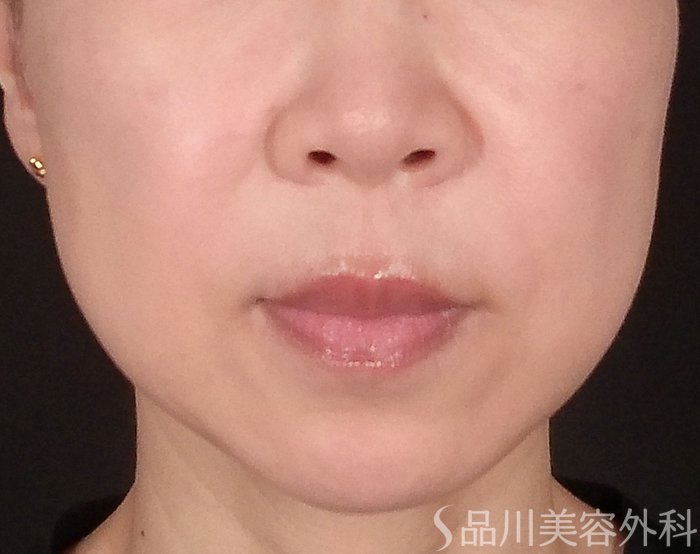 「美肌糸リフト」症例写真 After