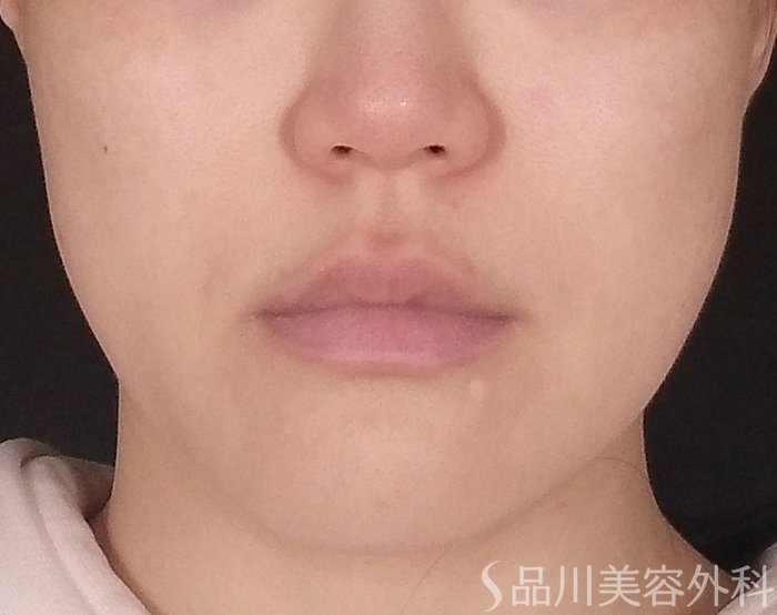 「美肌糸リフト」症例写真 Before