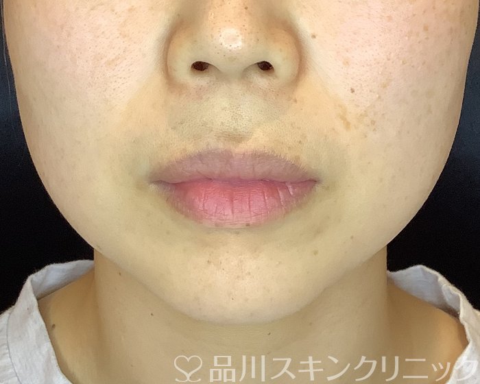 「美肌糸リフト」症例写真 Before