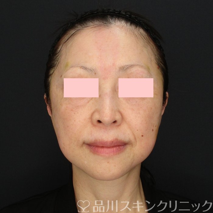 「美肌糸リフト」症例写真 After