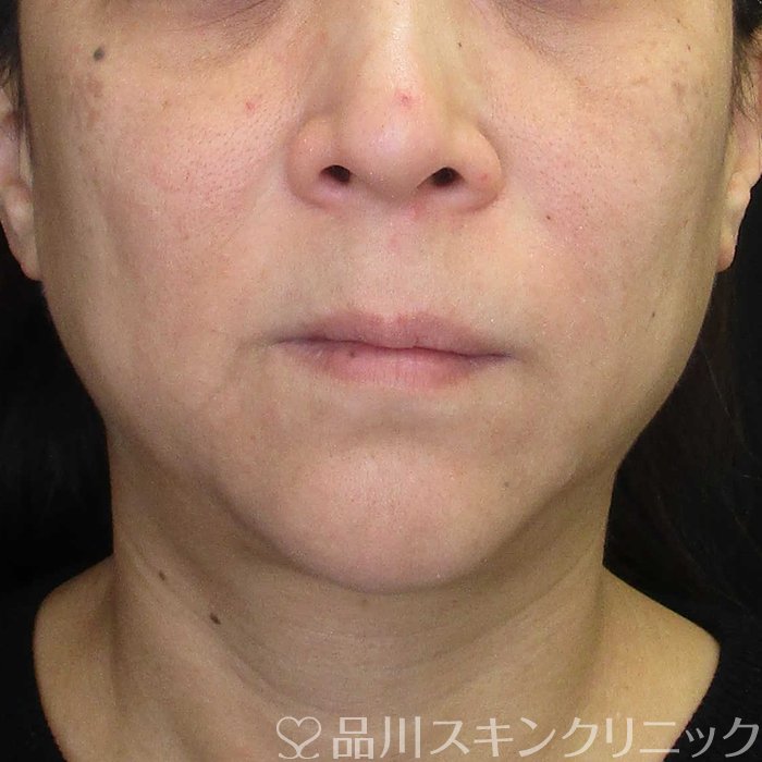 「美肌糸リフト」症例写真 Before