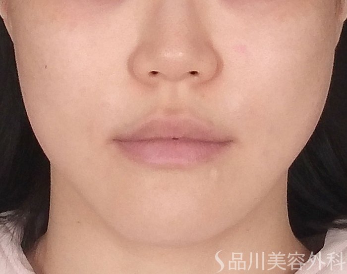 「美肌糸リフト」症例写真 After