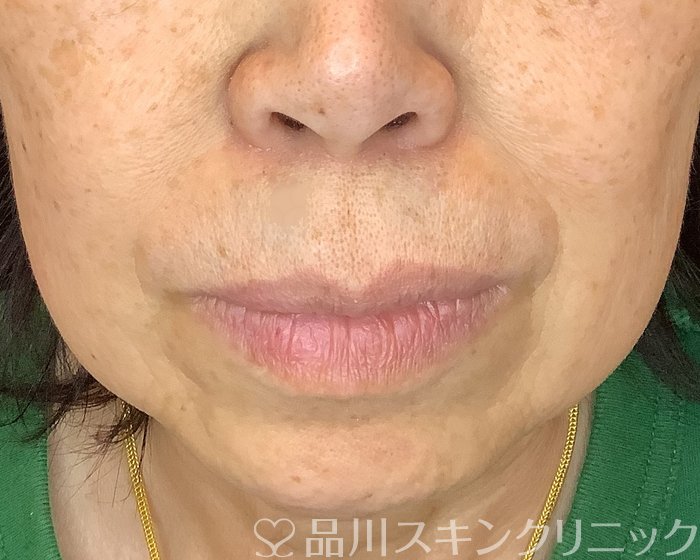 「美肌糸リフト」症例写真 Before
