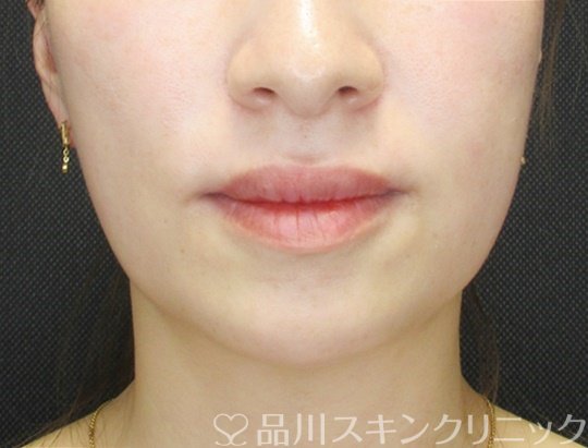 「美肌糸リフト」症例写真 Before