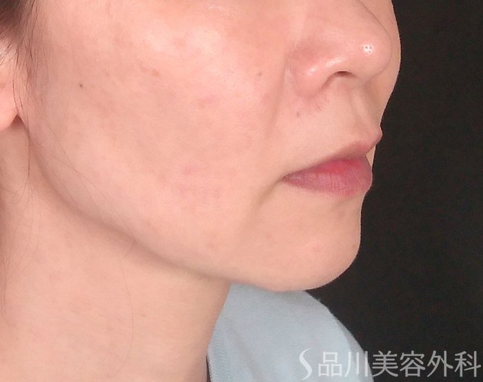「美肌糸リフト」症例写真 Before