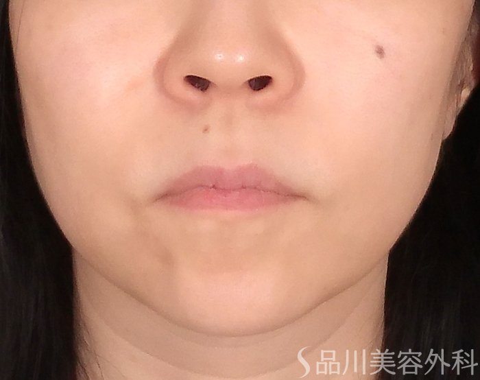 「美肌糸リフト」症例写真 After