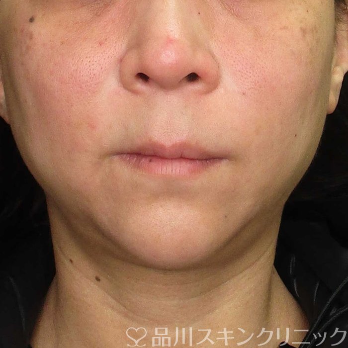 「美肌糸リフト」症例写真 After