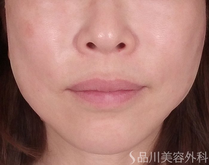 「美肌糸リフト」症例写真 After