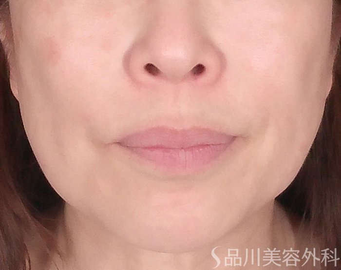 「美肌糸リフト」症例写真 Before