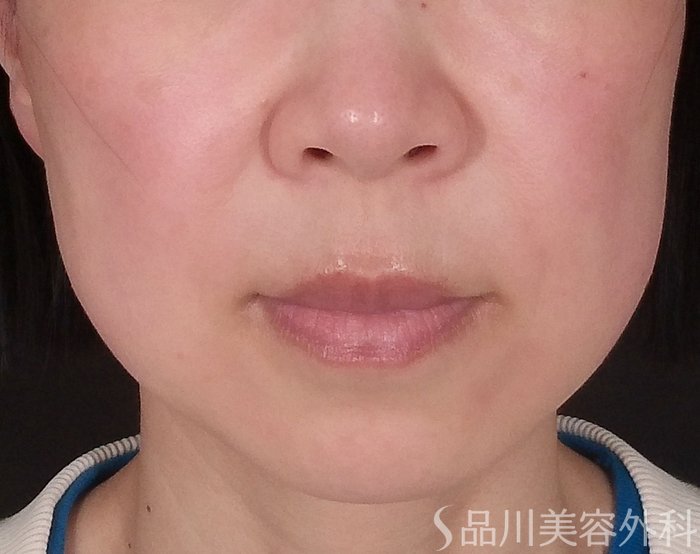 「美肌糸リフト」症例写真 Before